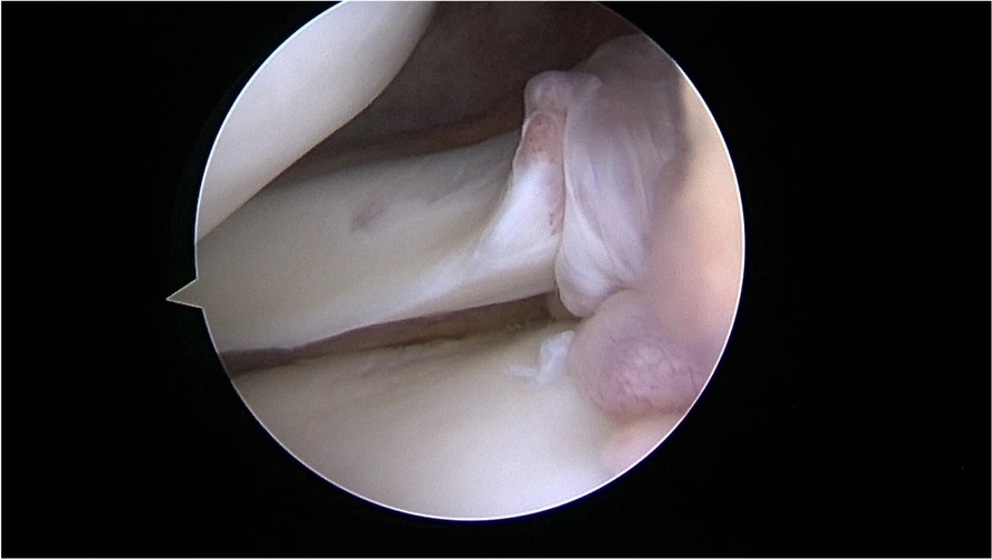 The aspiration test: an arthroscopic sign of lateral meniscus posterior horn instability. Publication in JEO
