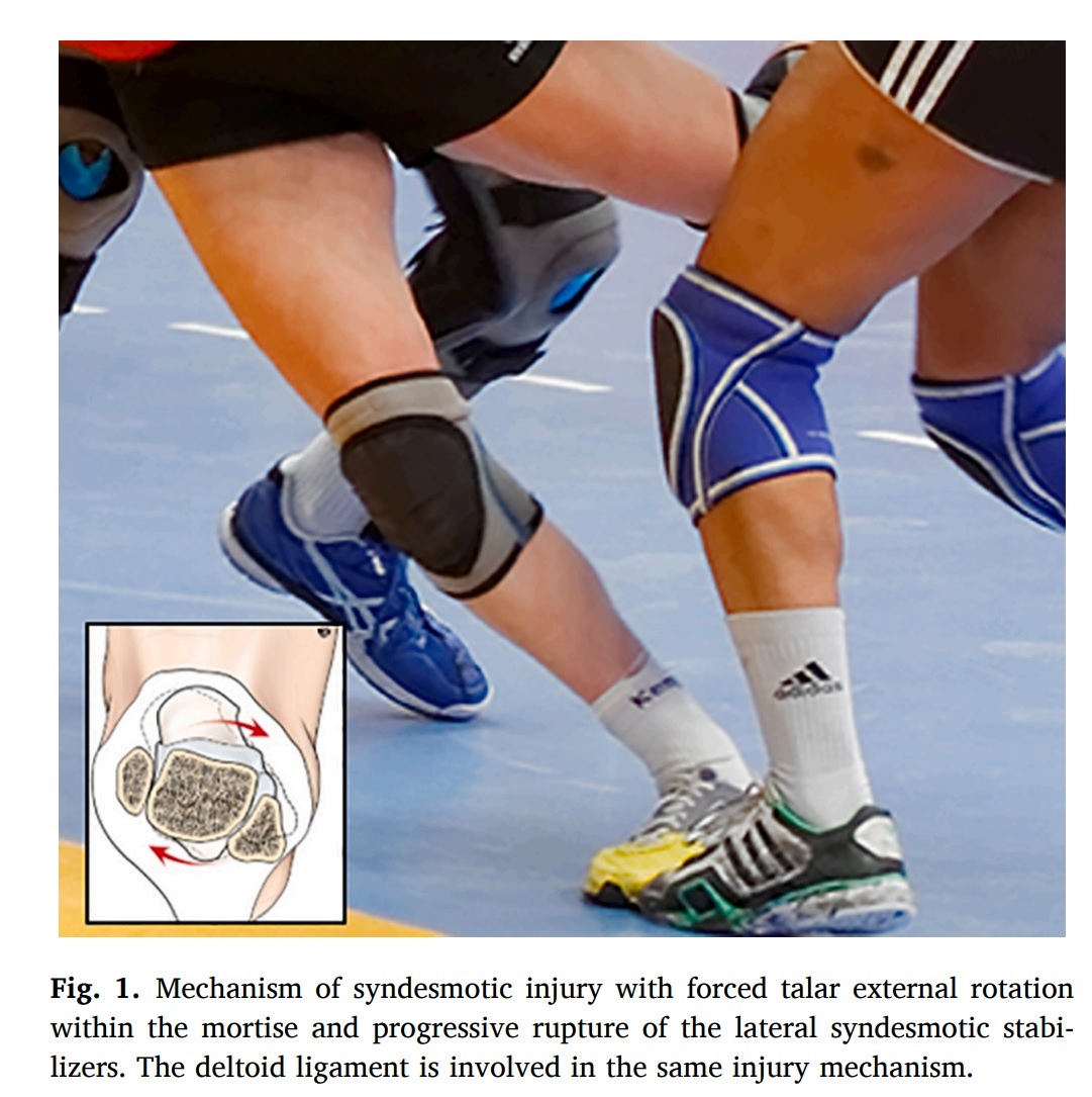 syndesmotic injury