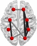 Functional Cortical Connectivity Related to Postural Control in Patients Six Weeks After Anterior Cruciate Ligament Reconstruction