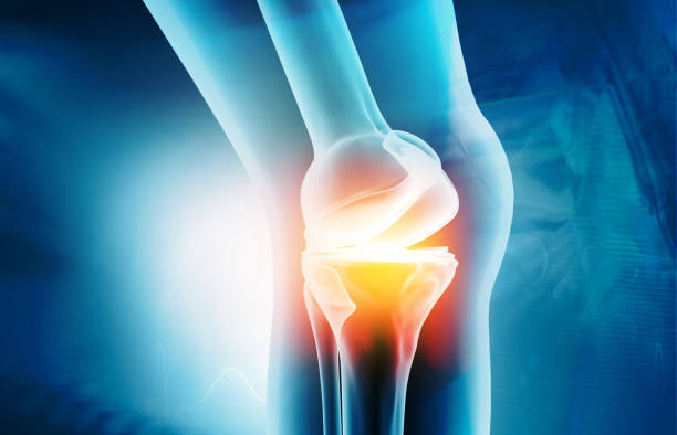 Medial meniscus ramp and lateral meniscus posterior root lesions are present in more than a third of primary and revision ACL reconstructions