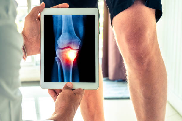 The posterior cruciate ligament–posterior femoral cortex angle: a reliable and accurate MRI method to quantify the buckling phenomenon of the PCL in ACL‐deficient knees